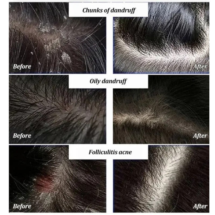 Anti-Dandruff Artemisia Conditioner-【BUY 2 GET 1 FREE】